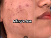 Trị Mụn Nám Chuyên Sâu Tại Nắng Spa – Giải Pháp Cho Làn Da Hoàn Hảo