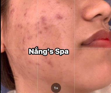Trị Mụn Nám Chuyên Sâu Tại Nắng Spa – Giải Pháp Cho Làn Da Hoàn Hảo
