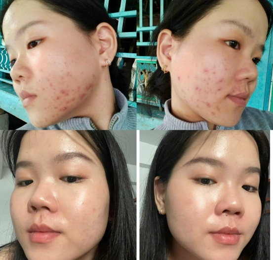 Feedback khách hàng mụn tại Nắng's Spa